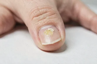 Gros plan d'un ongle épaissi et décoloré à la base illustrant une possible atteinte de la matrice ou une mycose unguéale